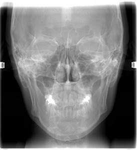 Telecranio con Craniostato