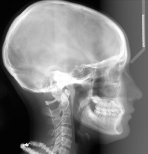 Telecranio Latero Laterale con Craniostato